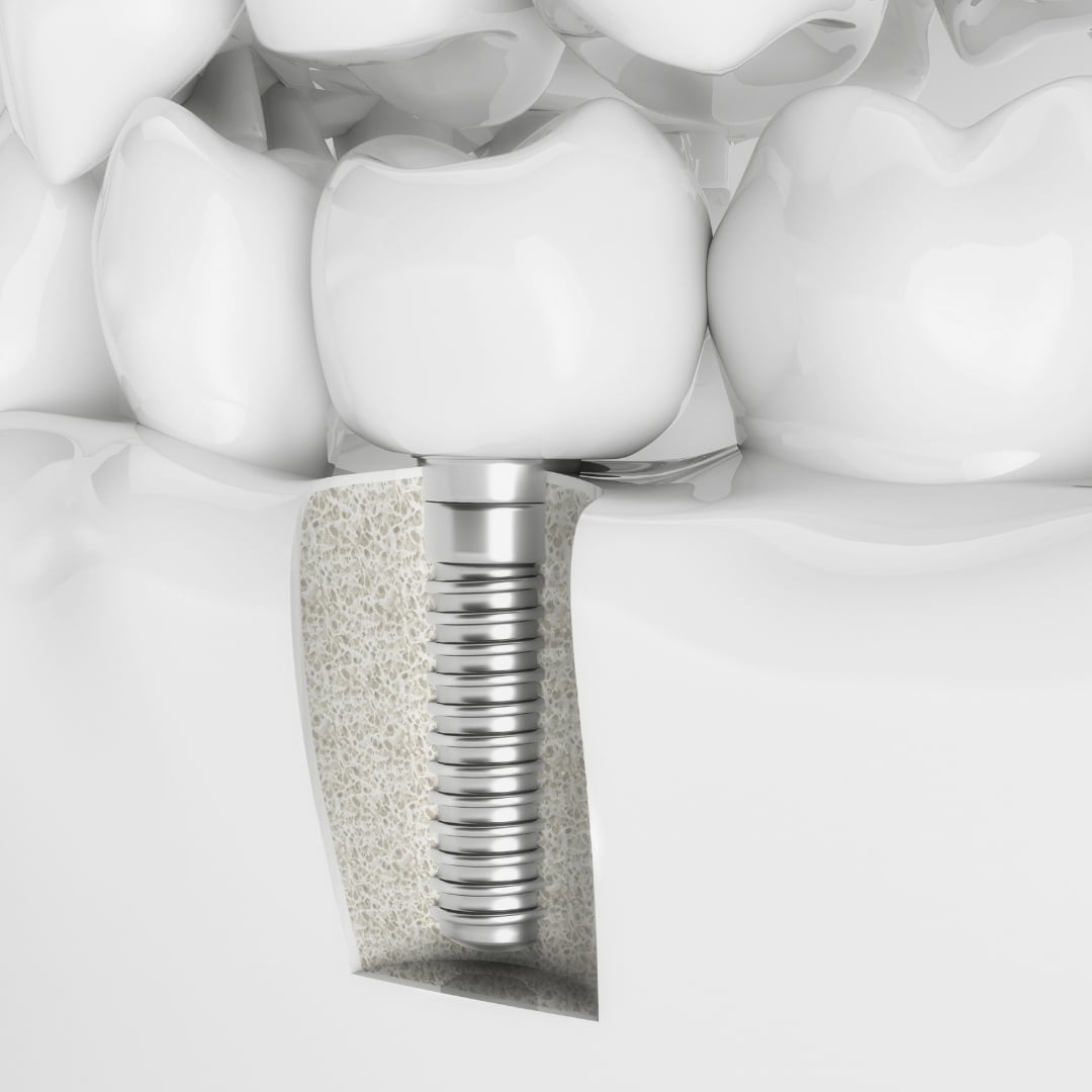 Dental Implants